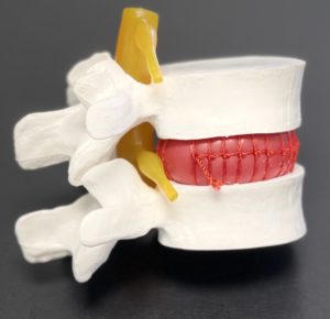 Normal disc