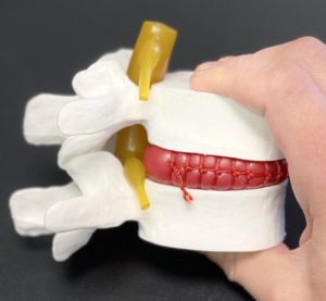 The bulging disc starts to crowd the nerve root(yellow)