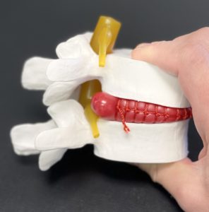 The disc herniation crowds and places pressure on the nerve root (yellow).