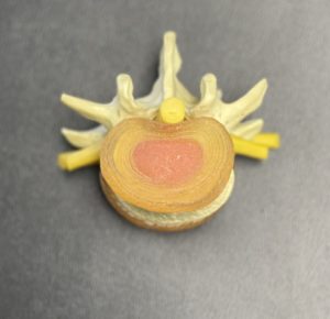 The rings of the annulus fibrosus keep the nucleus pulposus (in red) inside!