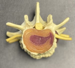 The nucleus pulposus (red) herniates and escapes from the center of the disc - causing pain and irritating the nearby tissues.